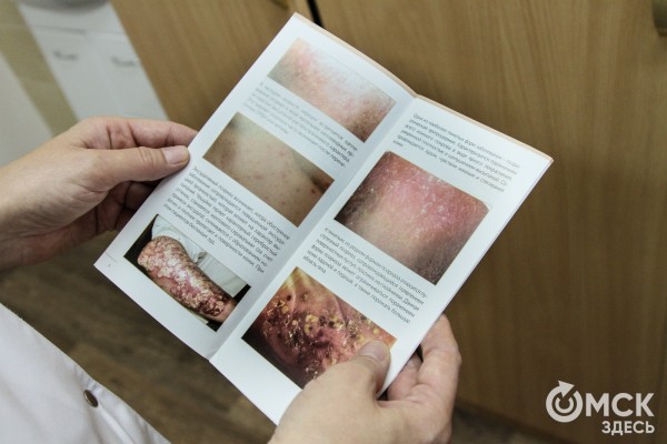 Это не заразно! Дерматолог развеивает мифы о псориазе