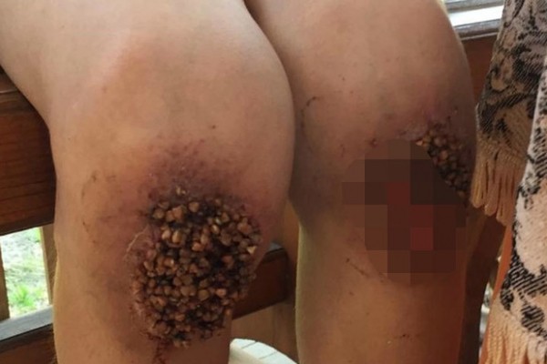 Колени - сплошная рана: родители часами заставляли ребенка стоять на гречке