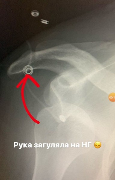 «Рука загуляла на Новый год»: жених Ольги Бузовой из Новосибирска вывихнул плечо