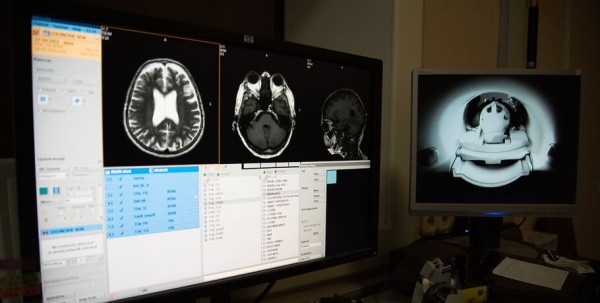 Дежавю может быть эпилептическим приступом. Врач о проявлениях и причинах болезни