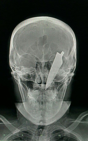 
									Из головы омича вытащили огромный нож: мужчина остался жив    [ФОТО]  