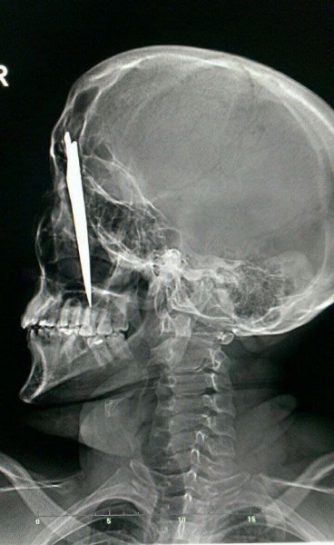 
									Из головы омича вытащили огромный нож: мужчина остался жив    [ФОТО]  