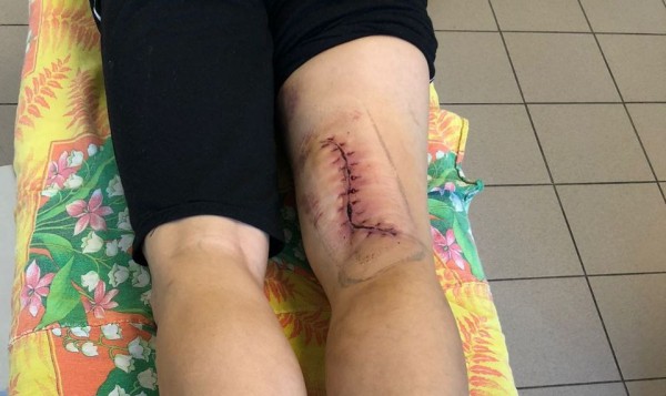 
									Омский фермер одним ударом случайно перерезал себе вену и артерию   [ФОТО]  