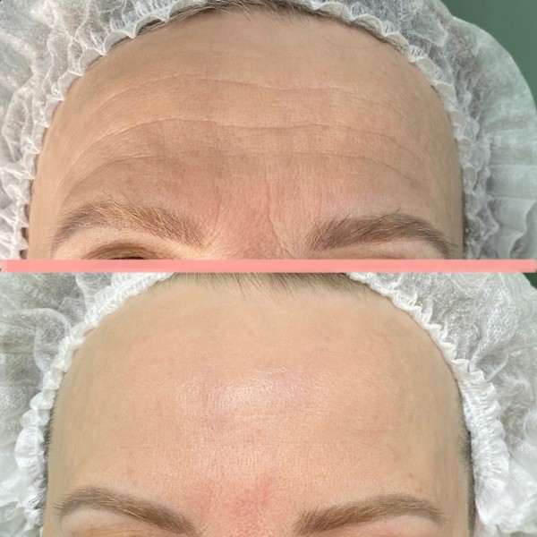 Как сохранить молодость лица без уколов красоты и пластики?
Как сохранить молодость лица без уколов красоты и пластики?