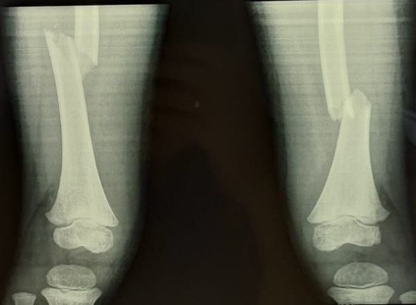 
									Юная омичка, спасаясь от огня, сорвалась с 5-го этажа и получила сложный перелом 